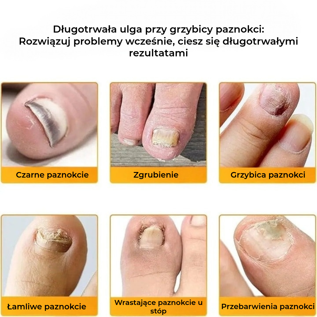 FungalPatch - Antybakteryjne Przeciwgrzybicze Plastry i Zestaw do Pielęgnacji Paznokci