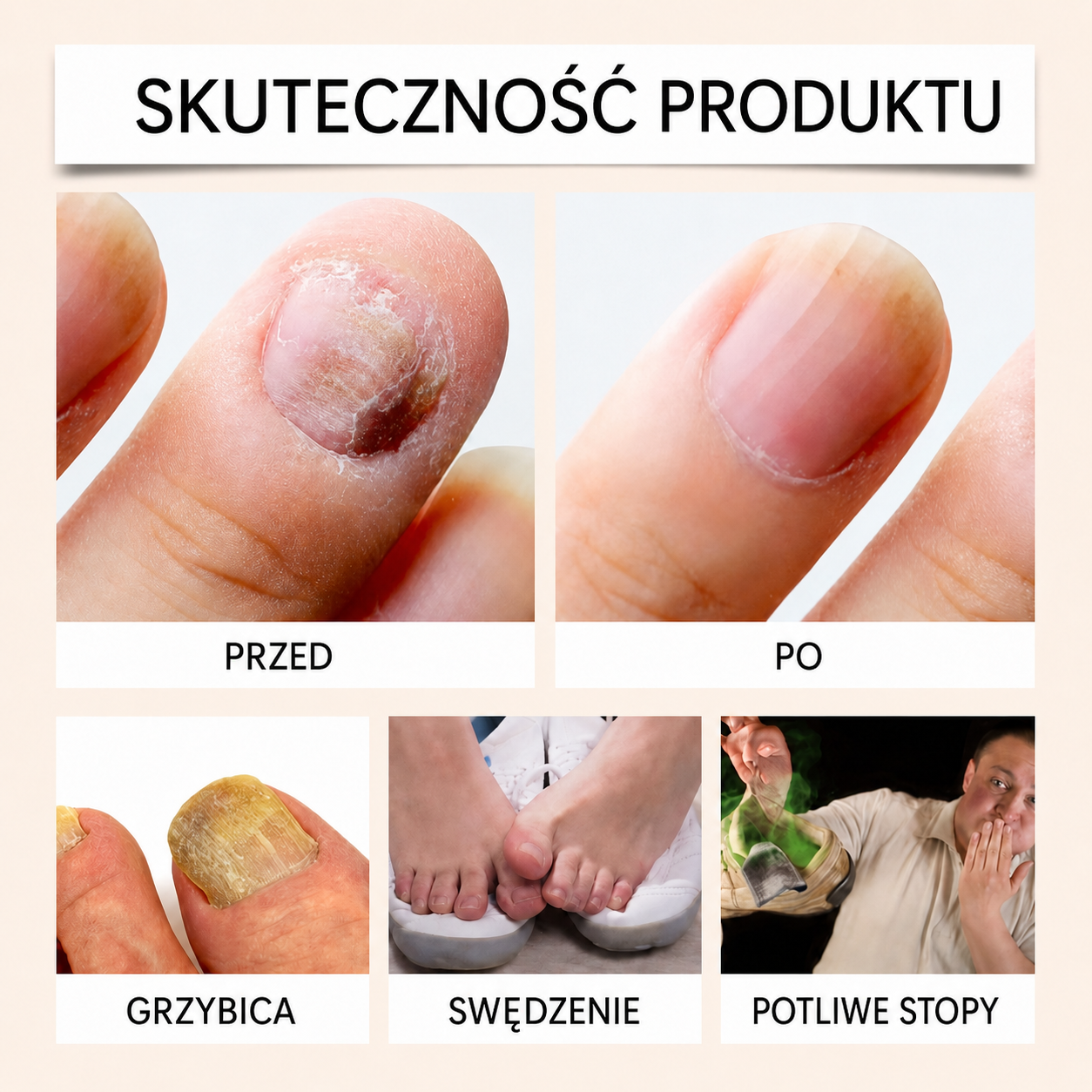 Spray z jadem pszczelim na grzybicę paznokci